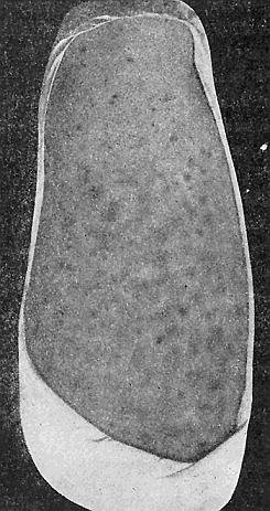 68. Melanoderma caused by the body
louse. From Portfolio of Dermochromes,
by permission of Rebman
& Co., New York, Publishers.