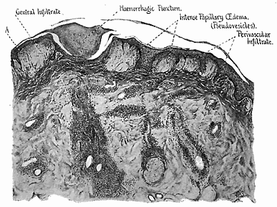 173. Fifth day mature lesion. Lower power drawing showing papillary œdema and infiltrate in the region
of the puncture.